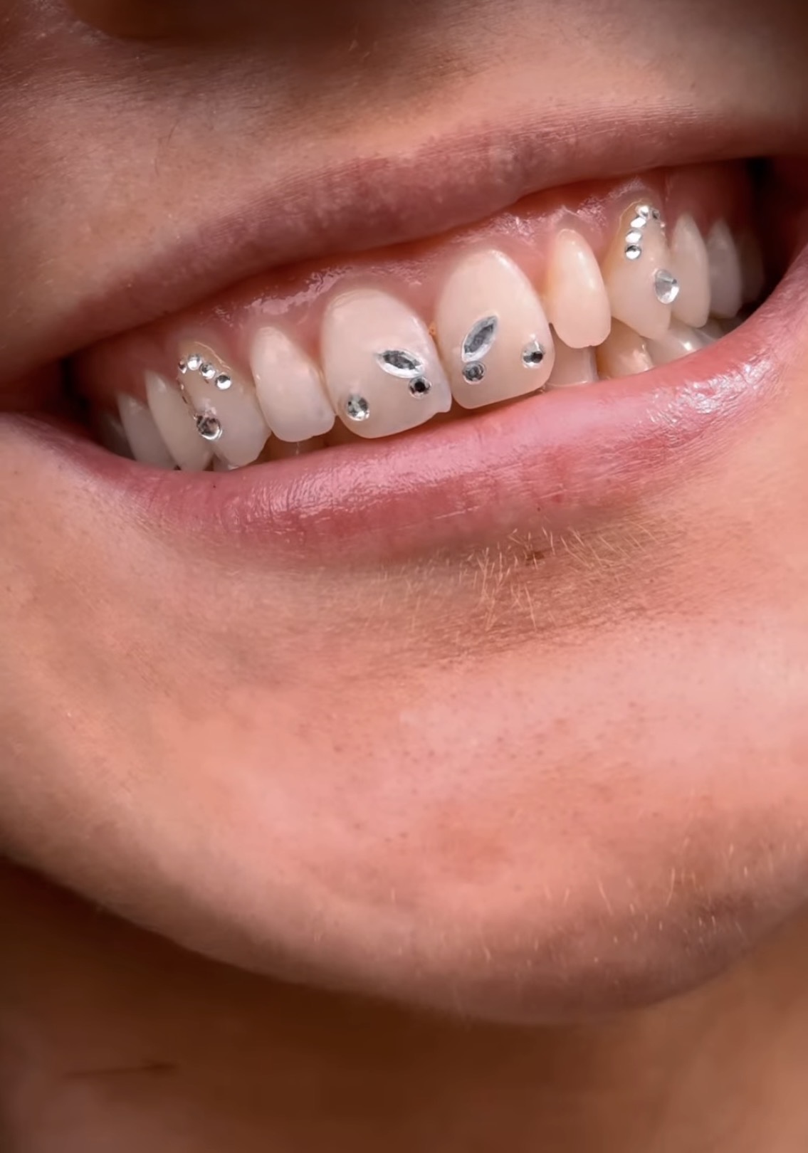 Tooth gem work