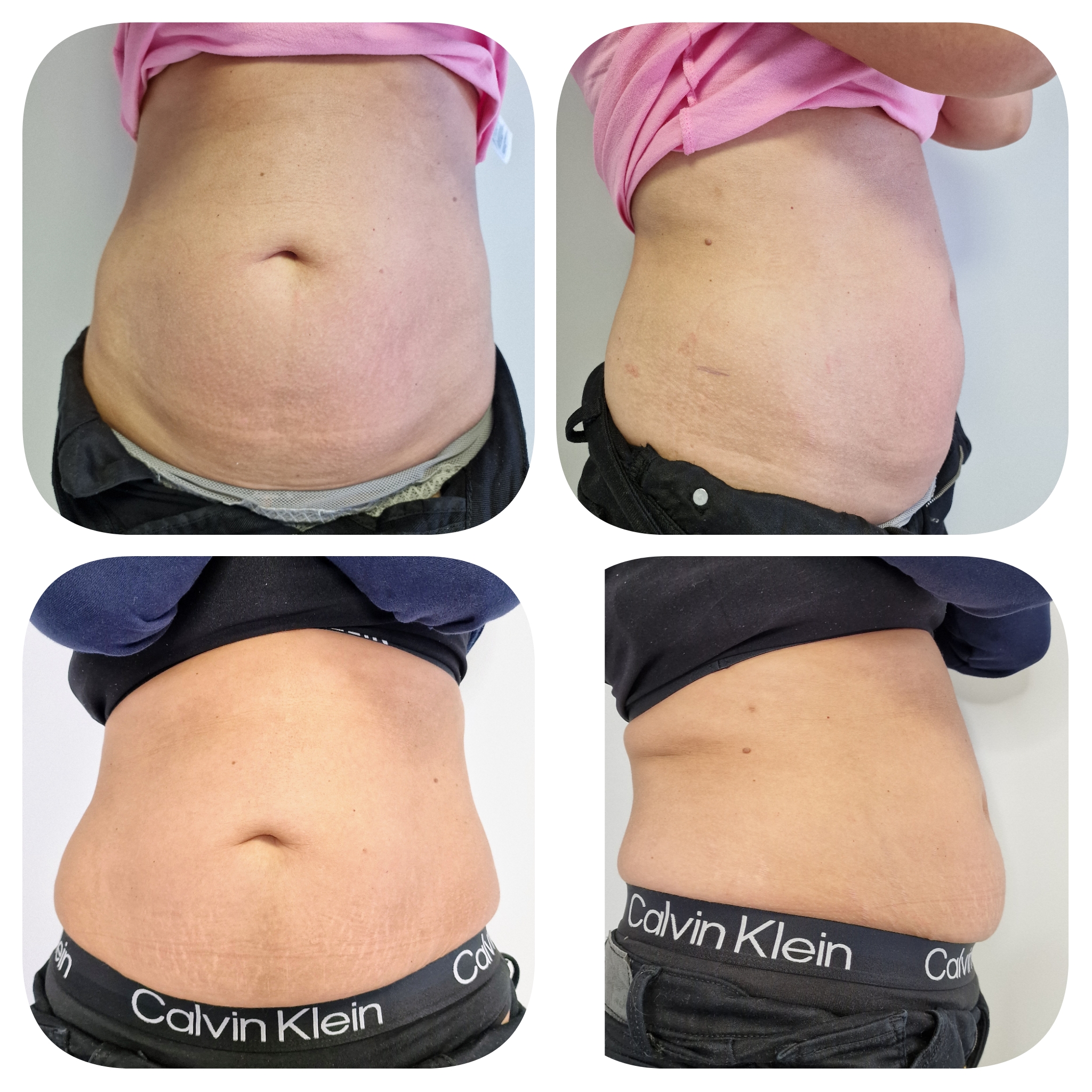 Stomach area before and after