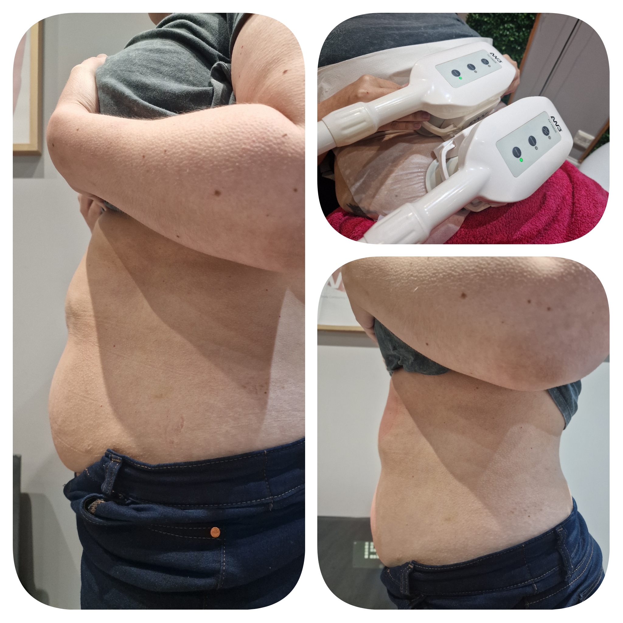 Body contouring before and after