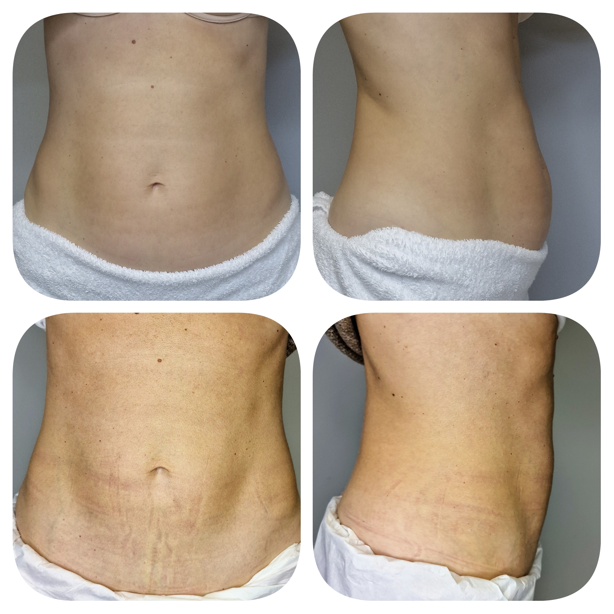 Body contouring results