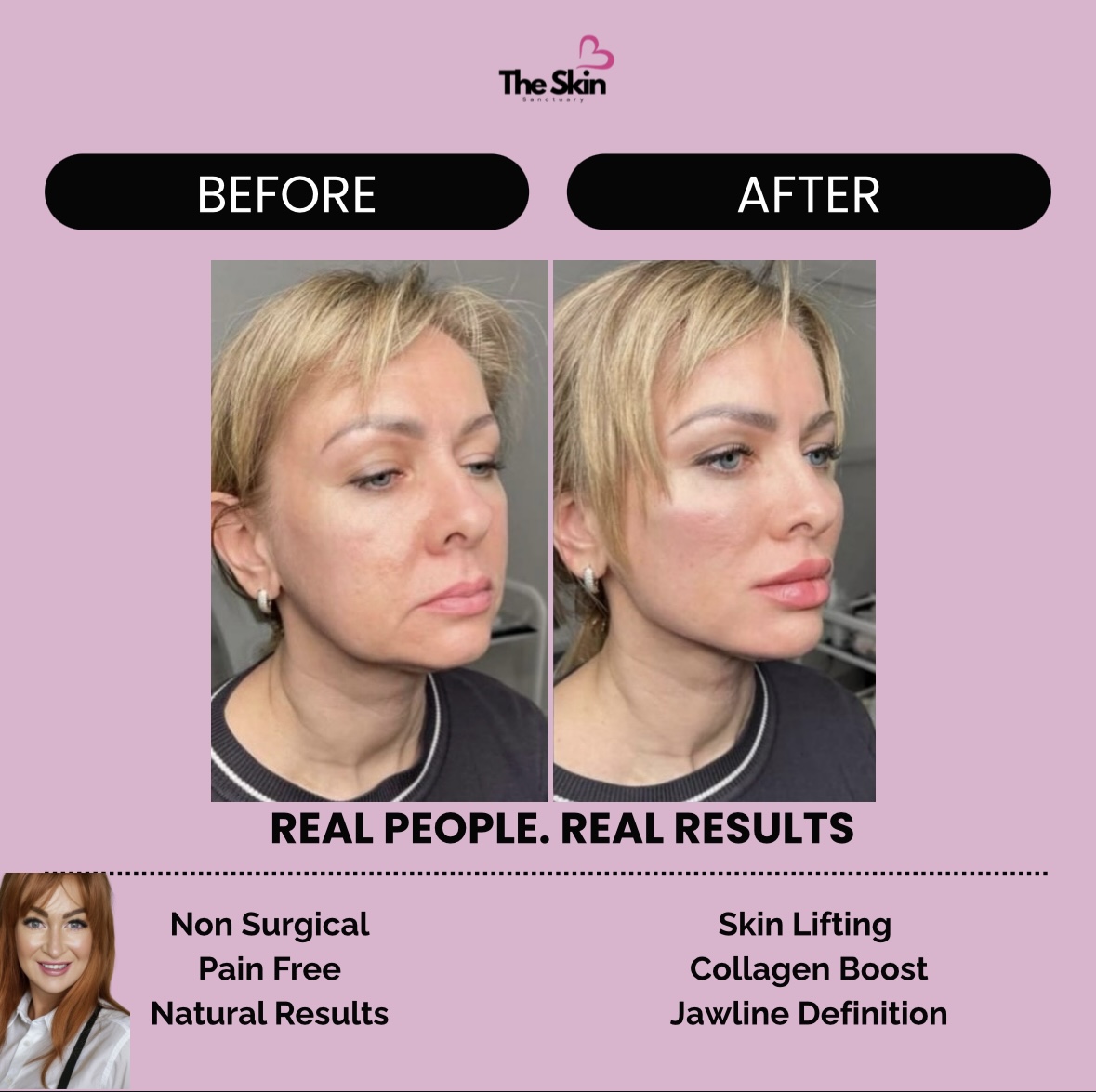 Before and after skin lifting and jawline definition treatment
