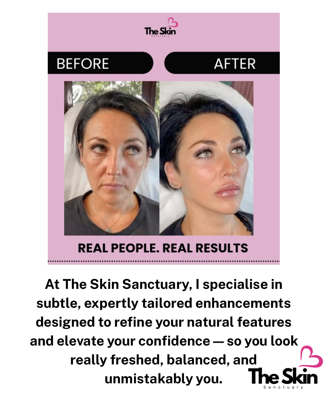 Before and after facial enhancement treatment